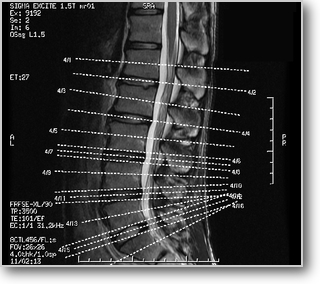 脊柱管狭窄症のMRI
