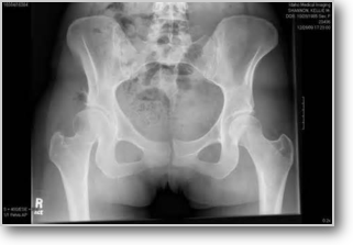 骨盤のx-ray画像